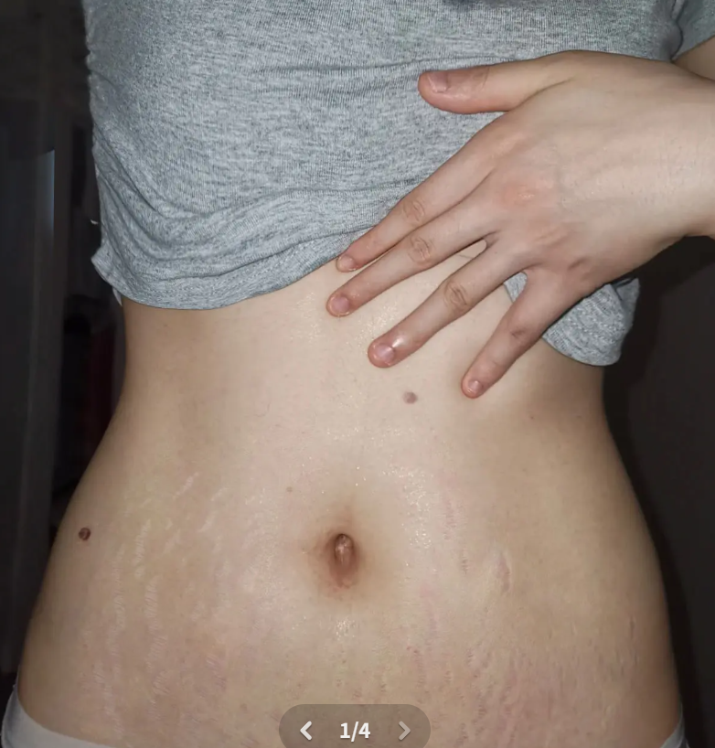 妊娠纹2